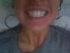 Before, veneer on peg lateral and implant on lateral incisor on the other side. Implant is tiny and yellow.