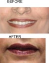 upper lip after and before the titan laser treatment.