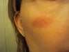 Laser treatment