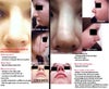 My rhinoplasties