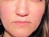 Mild Rosacea on cheeks, sometimes nose, forhead & chin.
