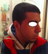 this is my nose 6 months afer surgery. just above the tip there is scarring tissue and i want it gone.