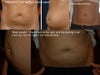 Here are some pictures from a year ago to recently.  You can see the wrinkly skin primarily around the belly button area.  