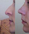 before and after at nine days postop