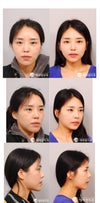 did she just have a mandibular setback or a le fort i osteotomy too?