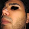 2 month after surgery