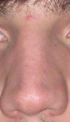 my pinched nose