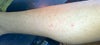 Laser burns, hyperpigmentation after 8 months