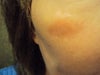 Lasered surface 7 weeks post op.