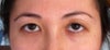 half asian, half caucasian, and my right eye folds like an asian eye