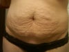 Wrinkle tummy 2 years post childbirth