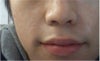 I would rather use something permanent and correct the problem completely, rather than just temporarily alleviate it with fillers
