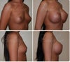 500cc implant