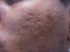 Left side cheek