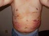 Early Detection of Post Lipo Complications