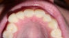 My teeth =(