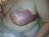 one week after surgery