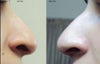 Both sides of my nose