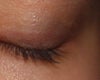 Eyelids
