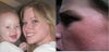 The first picture was taken about a year ago in early 2009 probably.  My son there was a year old and now he is two. The second picture was taken today, almost six months after my last laser peel.  My face has also done alot of healing since the last peel.  I also broke out also after the peels.  It has gotten better over the months.  