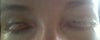 To photos. One (with dried blood - day 8, before stitch removal. 

the second one today - day 15 -- notice the bumps on inner part of the eyelid.