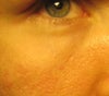 puffs, wrinkes, scar, burned skin