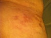 flank with red scars