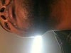 top lip two bulges