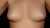 Breasts when nipples are not erect.