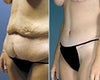 Before and After Tummy Tuck - Is this Real?
