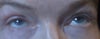 ptotis after upper eyelid surgery 3 1/2 weeks ago. it appears to be the same as right after surgery