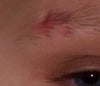 The red is from a healed scab I had the week before I took the pic, it isn't red there anymore.