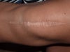 knee scar
