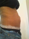 Is abdominal bulge swelling?