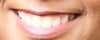 Want teeth to come more forward, wider smile, and close gaps. It's hard to tell from this picture.