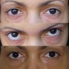 dark circles- first two pictures taken with natural light. Third picture indoors with flash
