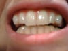 Canines are said to be approx. 50% rotated