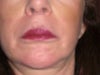 lip lift after 4 weeks