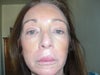 lip lift with make up