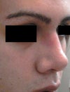 cartilage hump after rhinoplasty