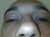 Swelling after 9 months