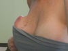 This was taken 1-12-11.  It is very hard, goes to the chest wall but not attached to the chest wall.  