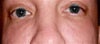 Creases under eyes make me look tired.