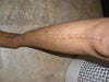 scar