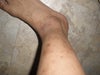 dark spots