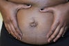 hernia bump
