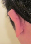 Keliod Top of Left Ear