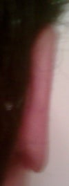 Right Ear "Perfect" no need to perform surgery
