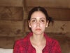 This is me 11 day post-op. I am not liking the results as of now.