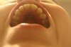 Top teeth from below.